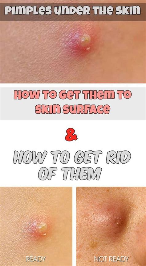 Fastest Ways to Get Rid of a Pimple - My Favorite Things | Pimples ...