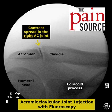 Subacromial Bursa Injection – Technique and Tips - The Pain Source - Makes Learning About Pain ...