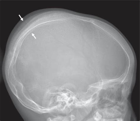 Periosteal Reaction | Radiology Key