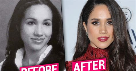 Meghan Markle Plastic Surgery & Nose Job Bombshell