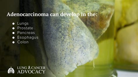 Adenocarcinoma - Lung Cancer Advocacy