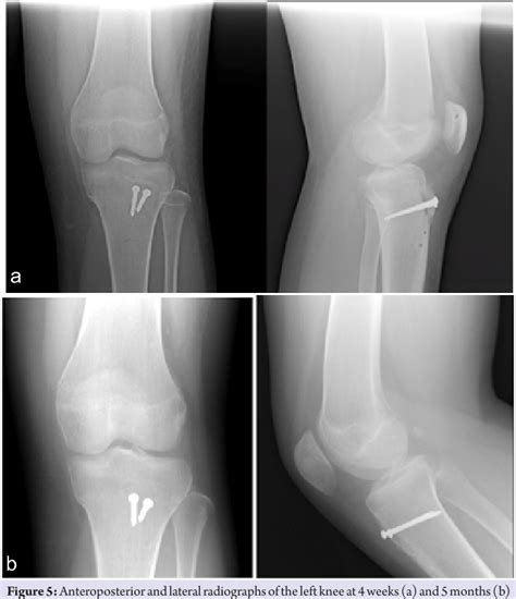 [PDF] Combined Tibial Tubercle Fracture and Patellar Tendon Avulsion: Surgical Technique and ...