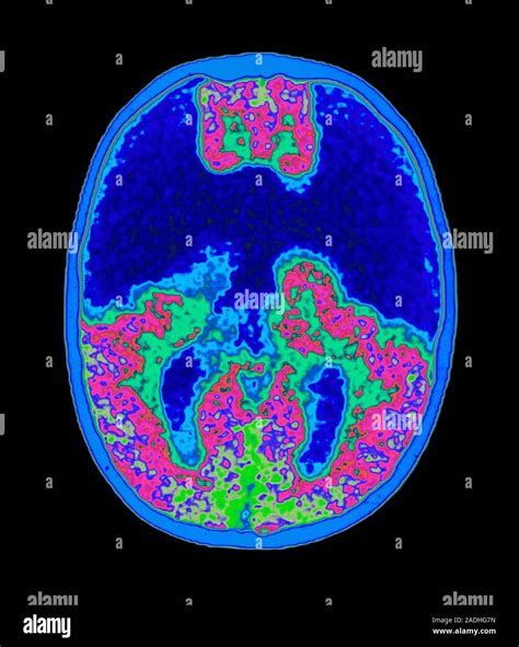 Holoprosencephaly On Ultrasound