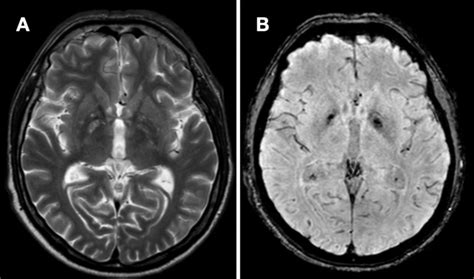 Magnetic resonance imaging (MRI) of the encephalon. A) T2 with ...