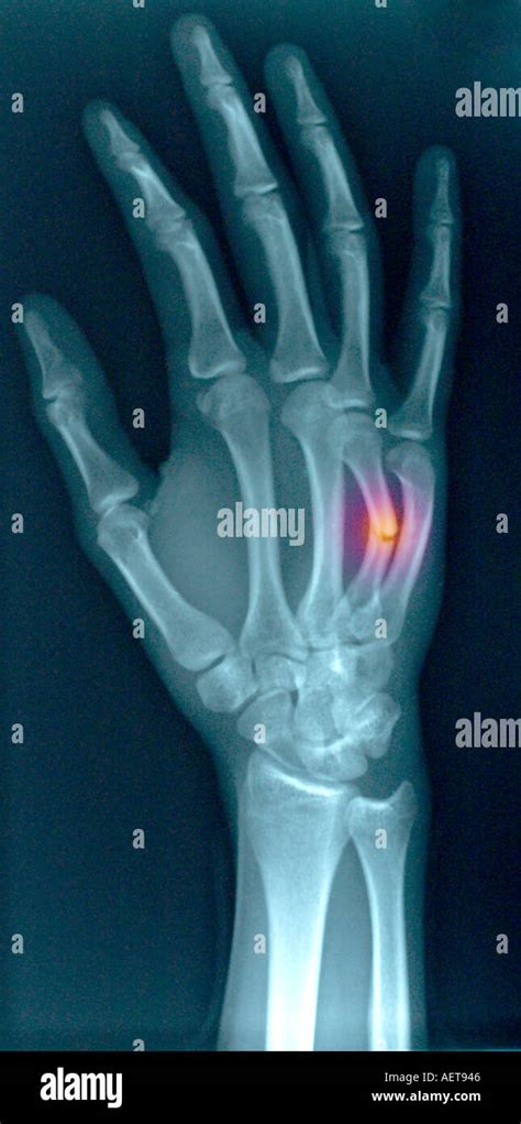 xray of hand with fractured ring finger metacarpal Stock Photo - Alamy