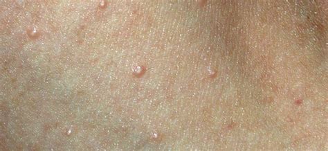 Update on Clinical Management of Cutaneous Molluscum Contagiosum