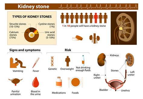 Kidney Stone Pain Chart