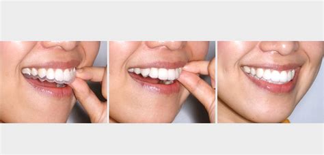 Align Braces Clinic for Orthodontic Care in Singapore - MEOC