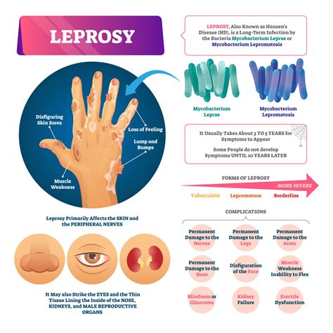 Understanding Leprosy on World Leprosy Day - GIDEON - Global Infectious Diseases and ...