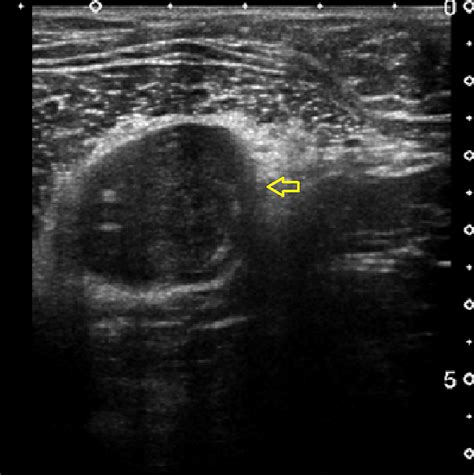 Chest Wall Schwannoma: Case Report and a Review of Imaging Findings | Cureus