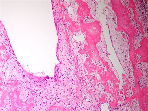 Aneurysmal Bone Cyst Jaw Histology