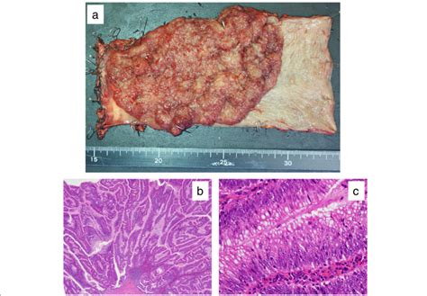 Surgical specimen and microscopic findings. a A villous tumor at gross... | Download Scientific ...