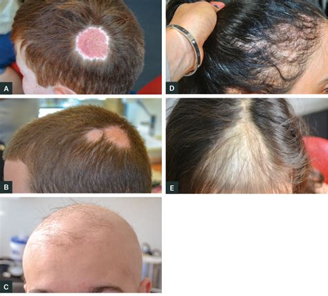 Hair Loss (Alopecia): Causes, Symptoms, And Regrowth, 42% OFF