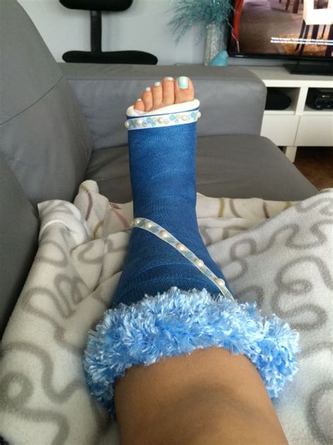 Pimp my orthopedic cast Orthopedic Cast, Orthopedic Surgery, Long Leg Cast, Arm Cast, Broken ...