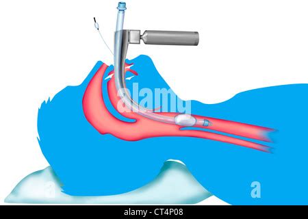 TRACHEAL INTUBATION Stock Photo, Royalty Free Image: 49277545 - Alamy