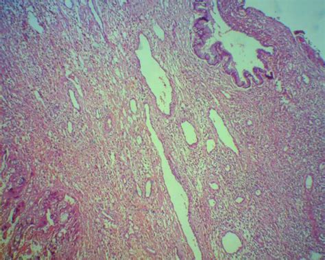 Endocervical Mucosa (Upper Right) With Beneath Neoplastic Trophoblasts ...