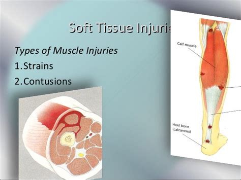 Soft tissue injuries