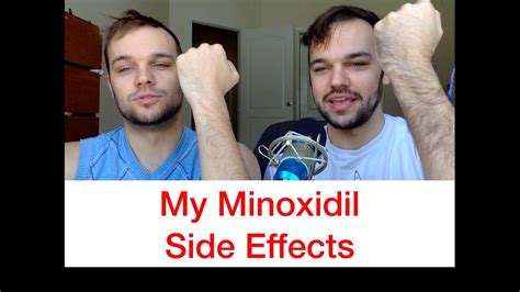 My Minoxidil Side Effects - YouTube