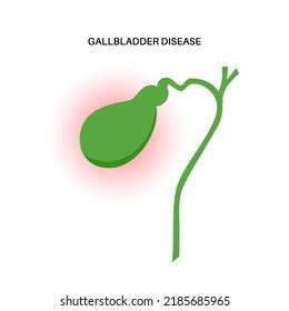 Gallbladder Diseases Infographic Gallstone Cancer Acute Stock Vector (Royalty Free) 2185685965 ...