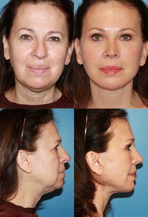 Facelift Surgery in San Diego | Face lift surgery, Mini face lift, Facelift procedure