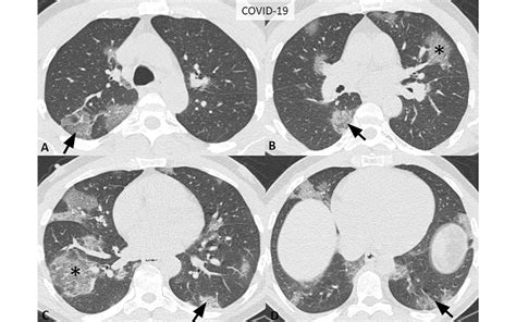 Consensus-COVID-19-Reporting