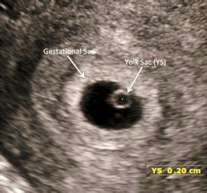 Introduction to First-Trimester Point-of-Care Ultrasound - Point-of-Care Ultrasound ...