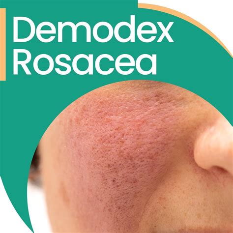 _ How to treat Demodex rosacea? . _ Ungex aims to eliminate mites with its innovative Care Plan ...