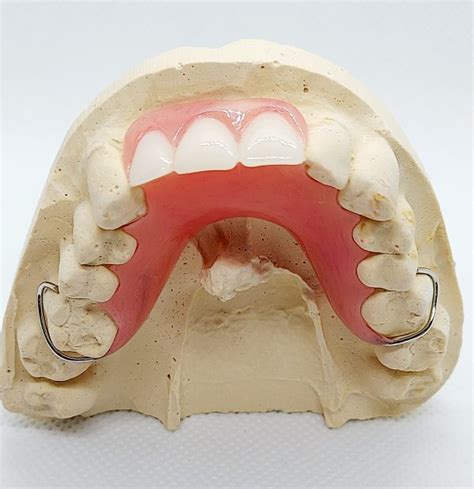 Acrylic Partial Denture – Dental Lab Direct