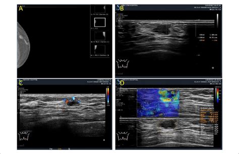 Mammogram and ultrasound imaging of the patient. (a) Mammogram shows a ...