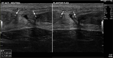 Cureus | Achilles Tendon Rupture: Can the Tendon Gap on Ultrasound Scan ...