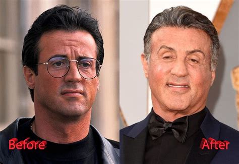 Sylvester Stallone Before and After Cosmetic Procedure | Filmstars, Schauspieler, Filme