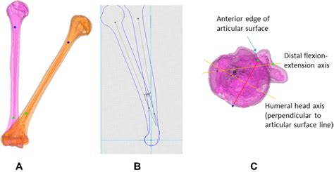 In three-dimensional measurements of cubitus varus, the anteroposterior... | Download Scientific ...