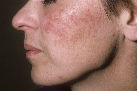 Rosacea Risk Influenced by Fatty Food, Dairy Intake - Dermatology Advisor