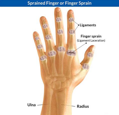 Cactus Thorn In Between Knuckles Pain And Swelling : I have had significant cactus spines in my ...