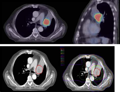 [PDF] Use of PET and PET/CT for radiation therapy planning: IAEA expert report 2006-2007 ...