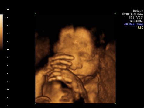 Advanced 3D Ultrasound Scans | Explore Your Baby's Features