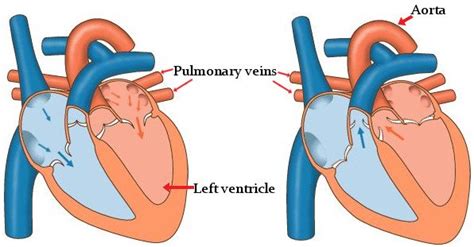 Orthopnea: Definition, Orthopneic Positions, Symptoms, Causes & Treatment