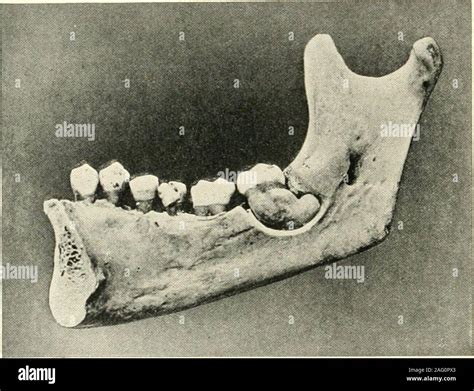 Periodontal membrane hi-res stock photography and images - Alamy