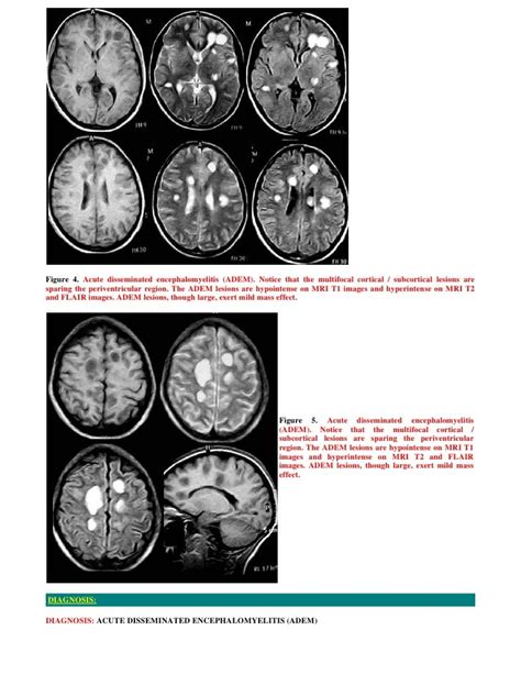 Case record... Acute disseminated encephalomyelitis