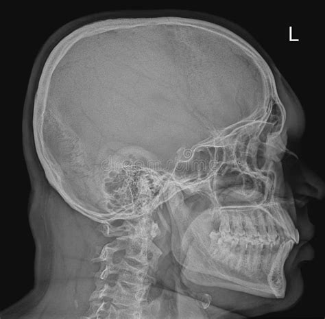 Lateral Skull X Ray Radiograph Stock Image - Image of anatomy, bones: 254956709