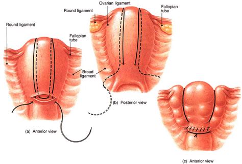 The B‐Lynch surgical technique for the control of massive postpartum haemorrhage: an alternative ...