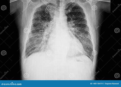 Chest Xray Film of a Patient with Cardiomegaly Stock Image - Image of ...