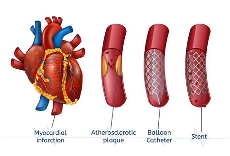 Has your Cardiologist Suggested You Need to Get a Stent Placed in Your ...