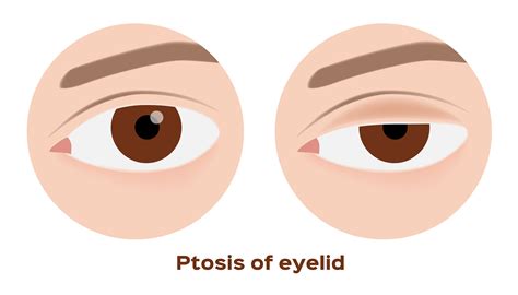 Ptosis: Causes, Symptoms, Treatment | Sunnyside Eye Doctor