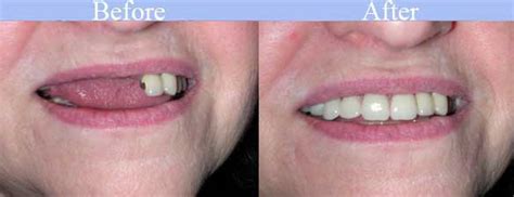 Get Removable Partial Dentures | Dentist Harrisburg NC