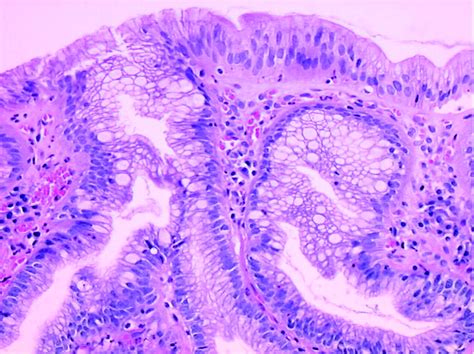 Barrett’s oesophagus: from metaplasia to dysplasia and cancer | Gut