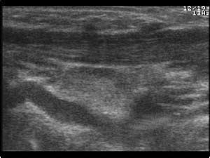 Head and Neck | 4.5 Miscellaneous : Case 4.5.5 Sternocleidomastoid muscle | Ultrasound Cases