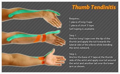 Image result for k tape de Quervain's Tenosynovitis | Kinesiology taping, Thumb tendonitis ...