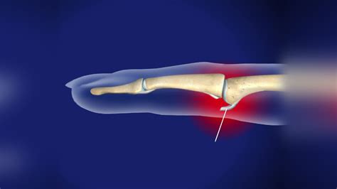 Ortho Blog | Volar Plate Injuries Video