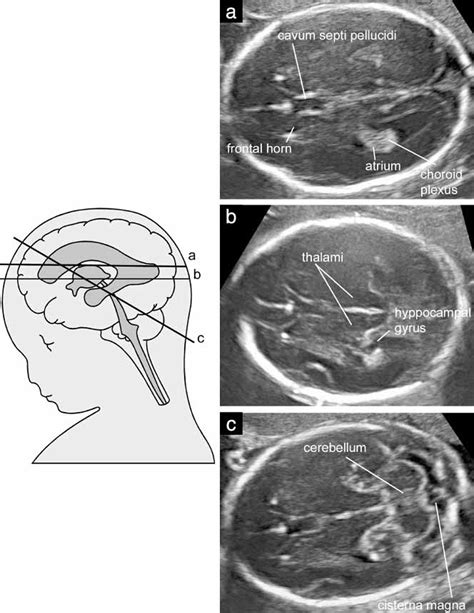 Sonographic examination of the fetal central nervous system: guidelines for performing the ...